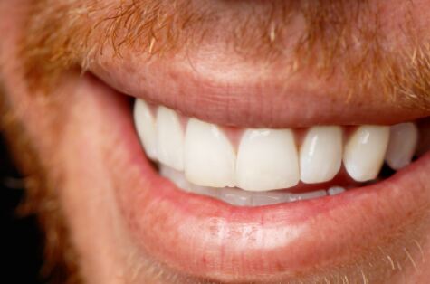 Veneers